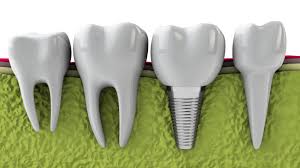 Implantologia-centro-dental-hortaleza-madrid