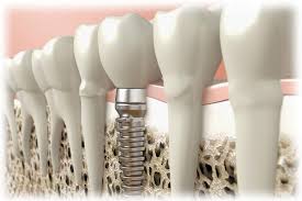 Tratamientos de implantología en Hortaleza - Dentistas en la Hortaleza (Madrid) - implantes dentales doctoresaguado