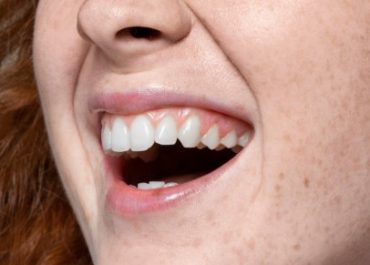 Blog Doctores aguado 2 | Clínica dental Doctores Aguado Encías retraídas: Por qué ocurren y cómo se tratan