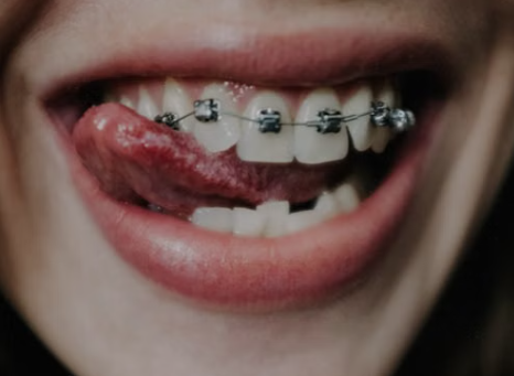 ¿Para qué sirve un irrigador dental? 1 | Clínica dental Doctores Aguado limpieza bucal con irrigador